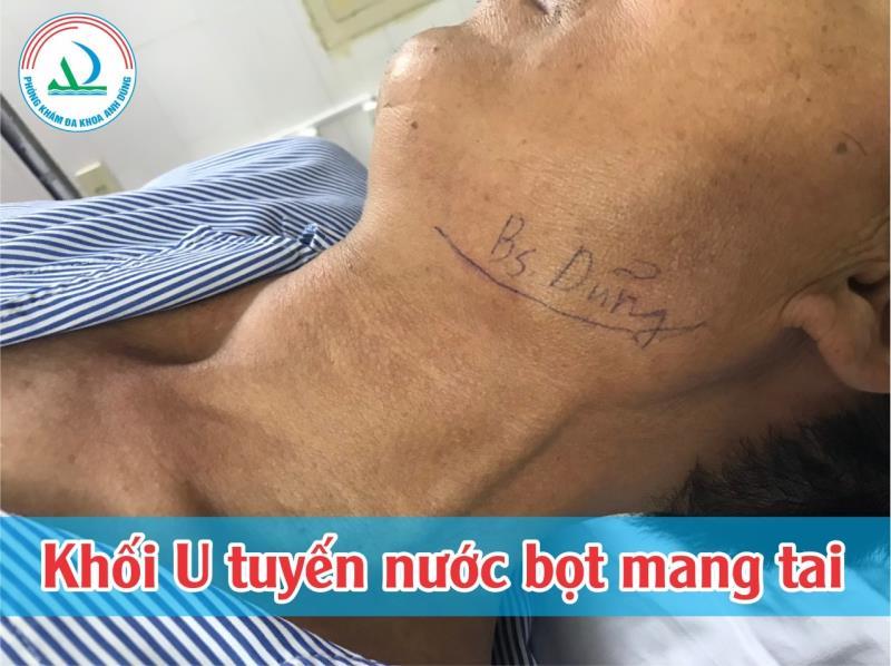 Phẫu thuật cắt U tuyến nước bọt dưới hàm tại khoa Răng - Hàm - Mặt